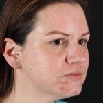 Chemical Peel Before & After Patient #3002