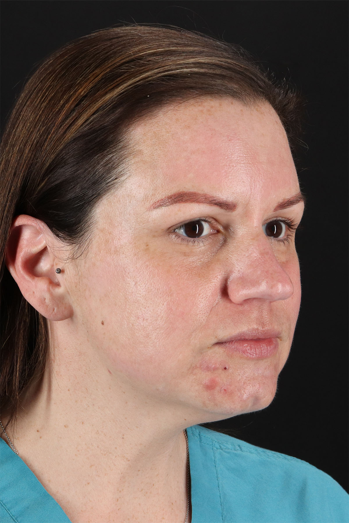 Chemical Peel Before & After Patient #3002