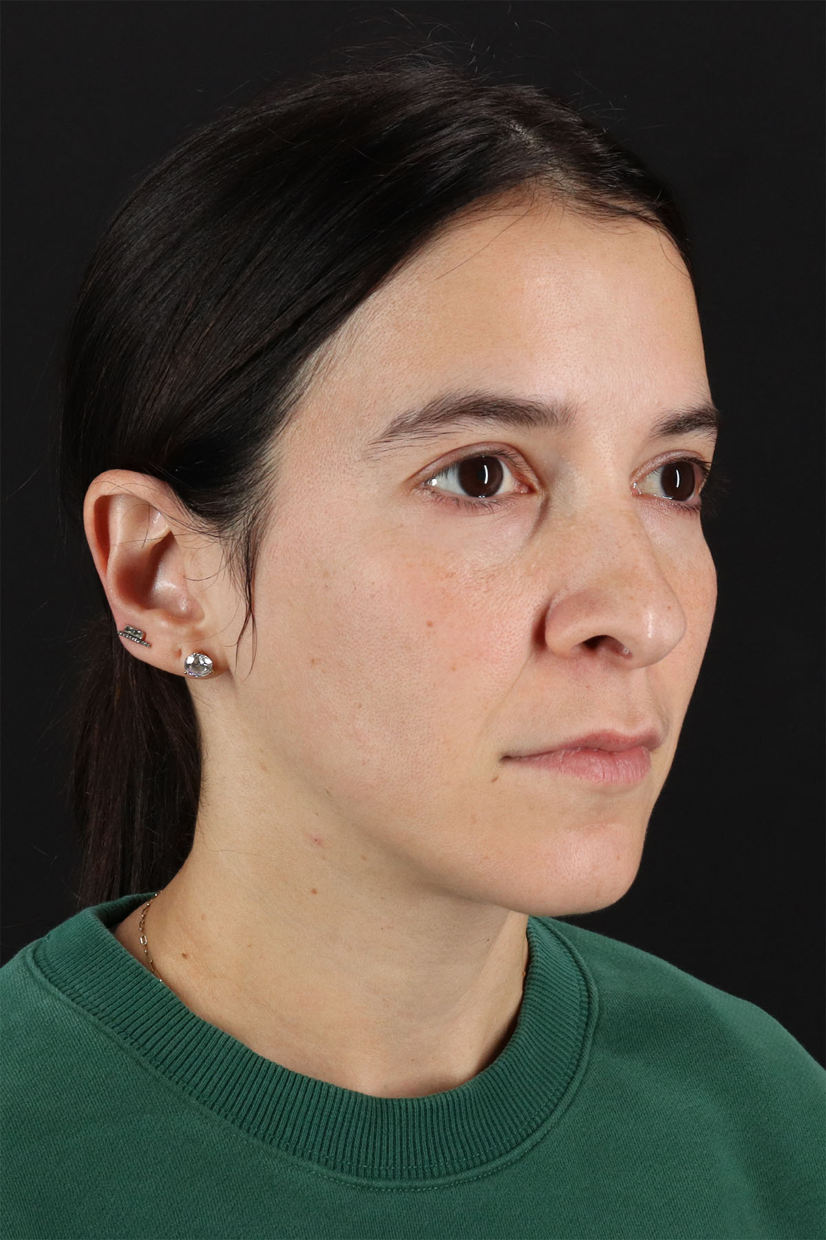 CO2 Laser Before & After Patient #3005