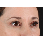 Eyelid Surgery Before & After Patient #3006
