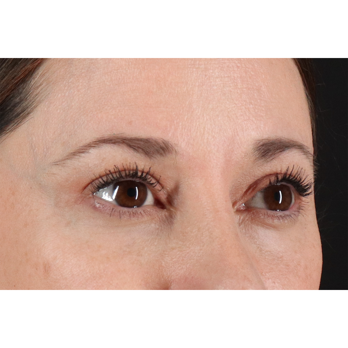 Eyelid Surgery Before & After Patient #3006