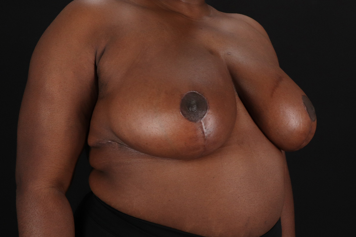 Breast Reduction with Lift Before & After Patient #3478