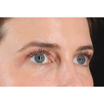 Eyelid Surgery Before & After Patient #3570
