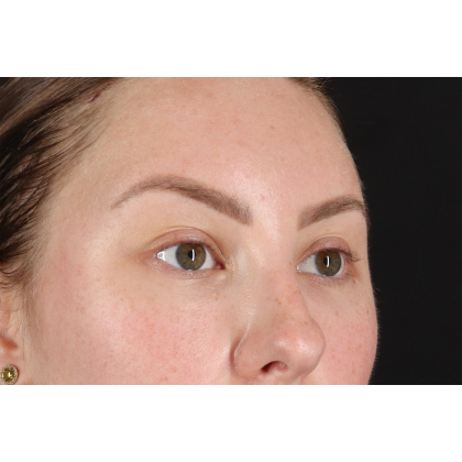 Brow Lift Before & After Patient #3111