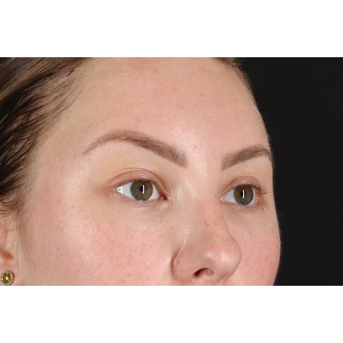 Brow Lift Before & After Patient #3111