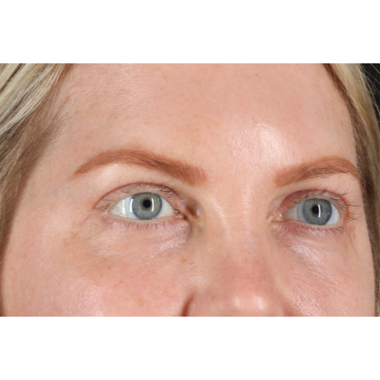 Eyelid Surgery Before & After Patient #3112