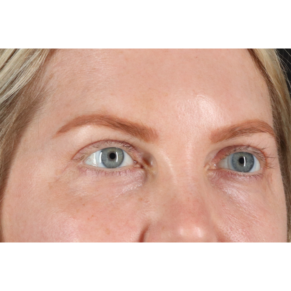 Eyelid Surgery Before & After Patient #3112