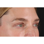 Eyelid Surgery Before & After Patient #3571