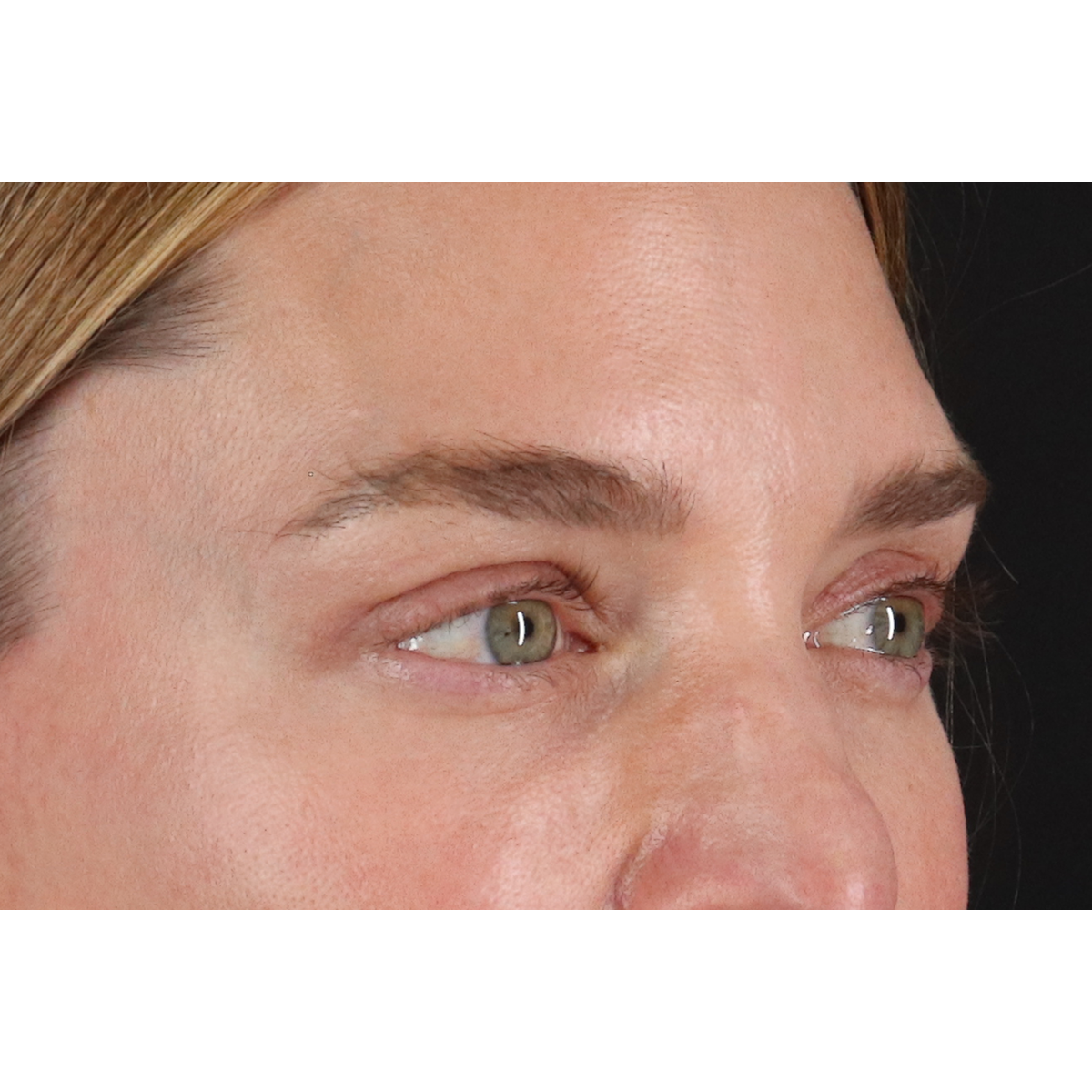 Eyelid Surgery Before & After Patient #3571