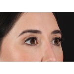 Eyelid Surgery Before & After Patient #3358