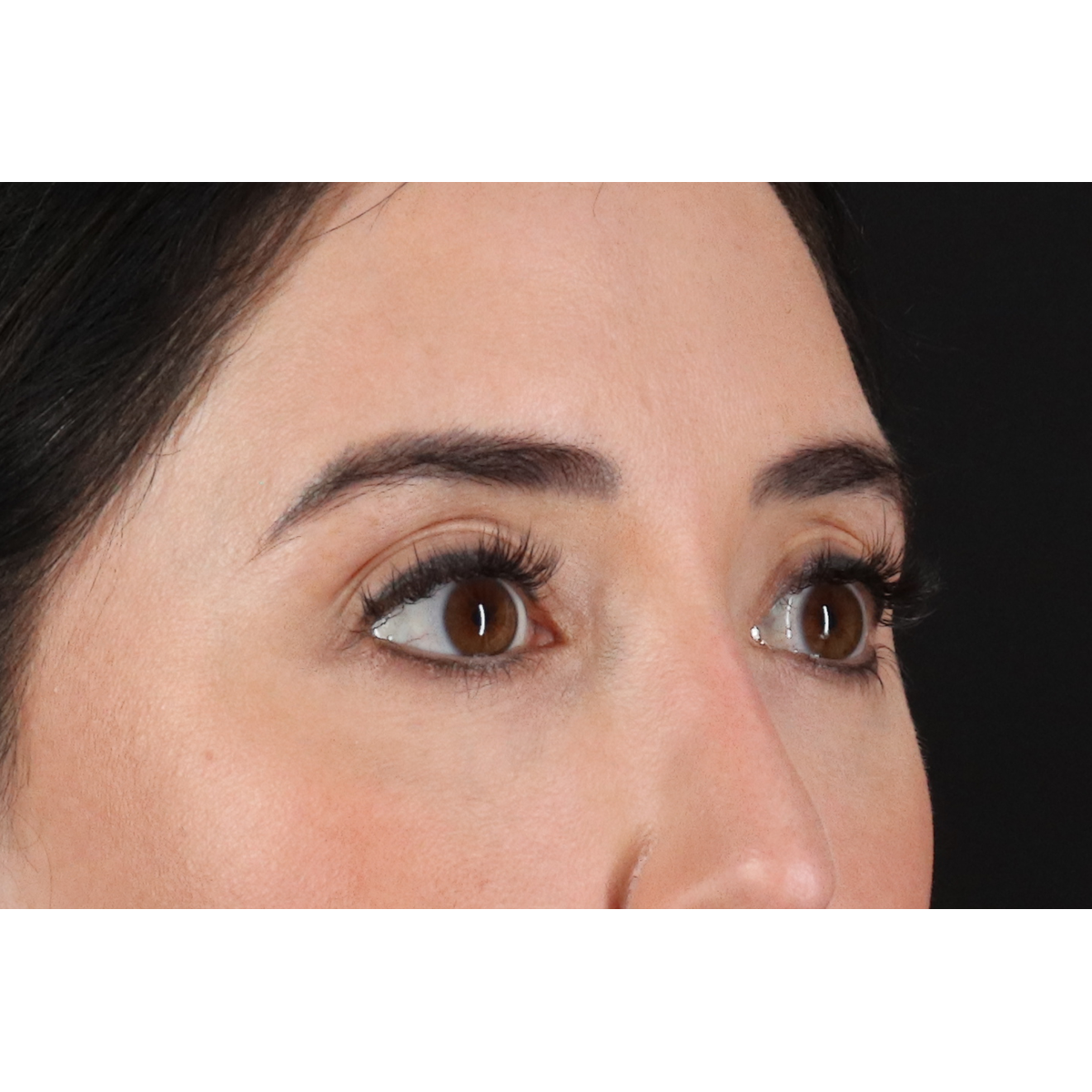 Eyelid Surgery Before & After Patient #3358