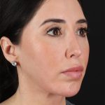 Structural Fat Grafting Before & After Patient #3649
