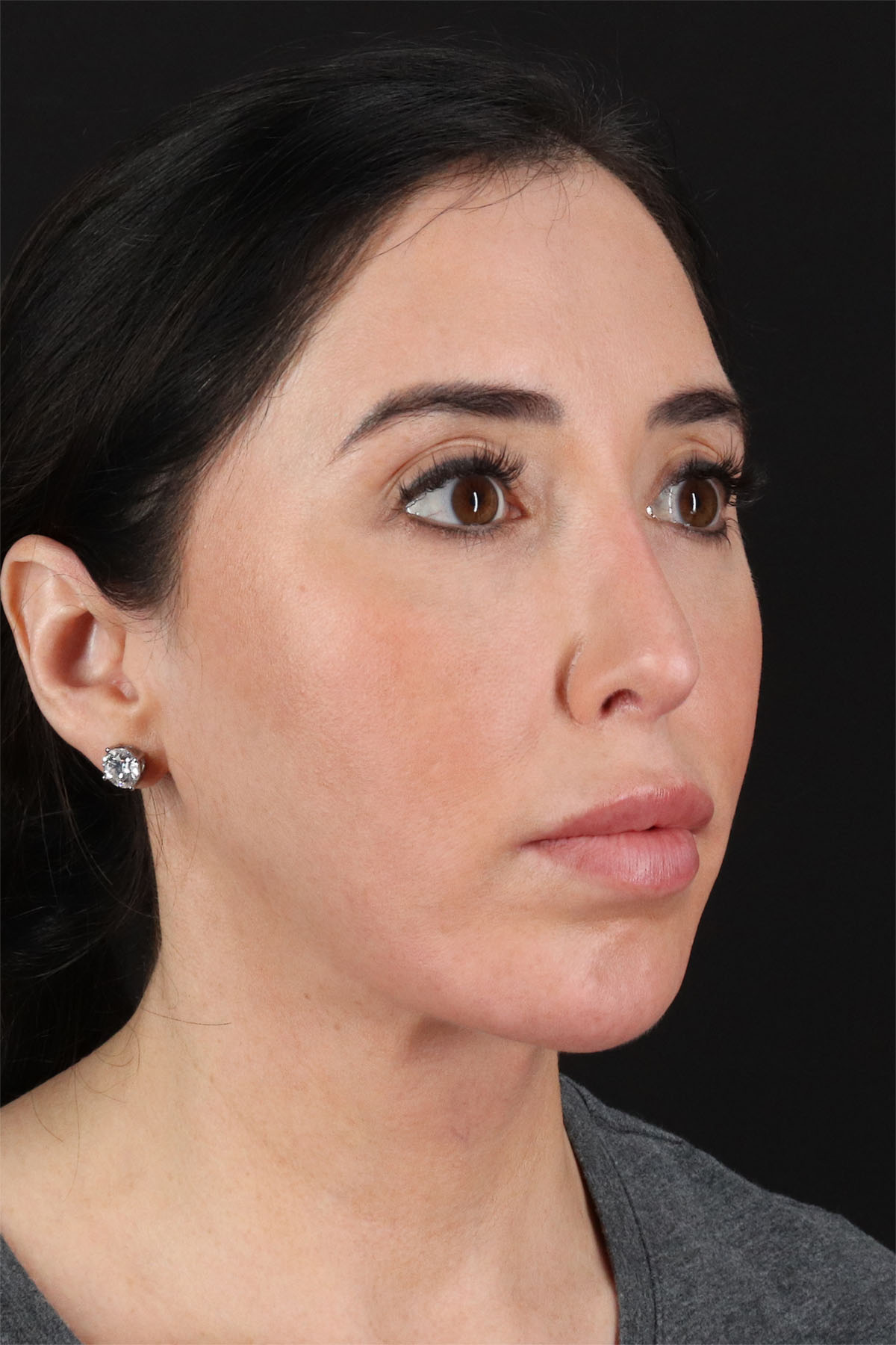 Structural Fat Grafting Before & After Patient #3649