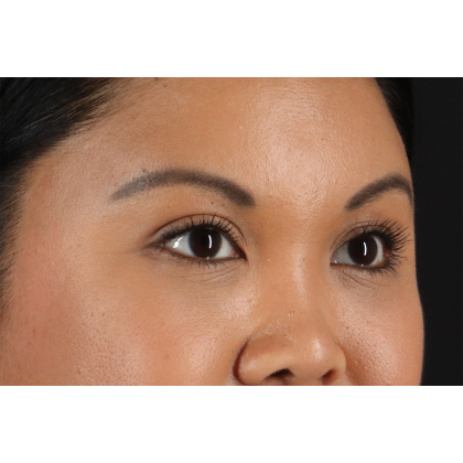 Brow Lift Before & After Patient #3114