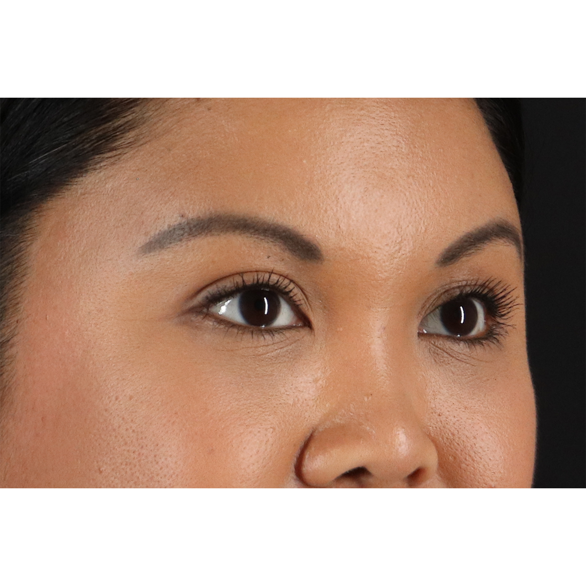 Brow Lift Before & After Patient #3114