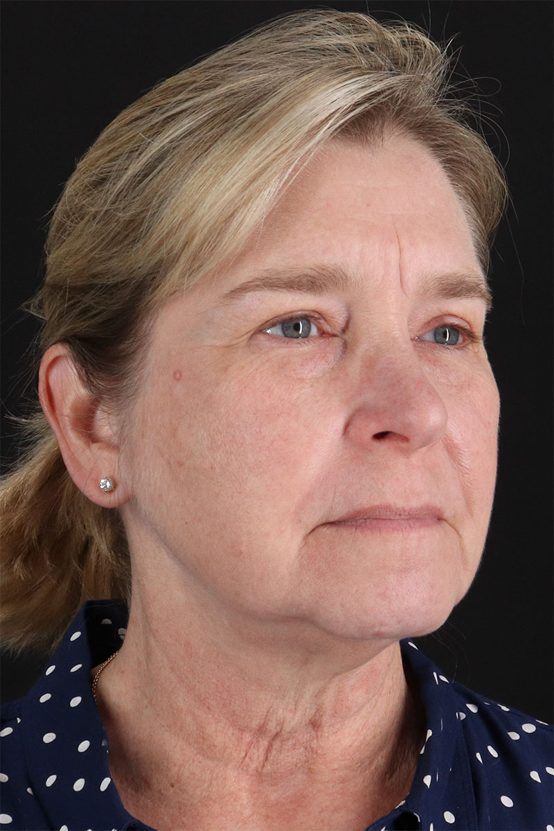 CO2 Laser Before & After Patient #3116
