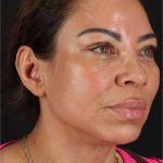 Laser Before & After Patient #3359