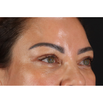 Eyelid Surgery Before & After Patient #3360