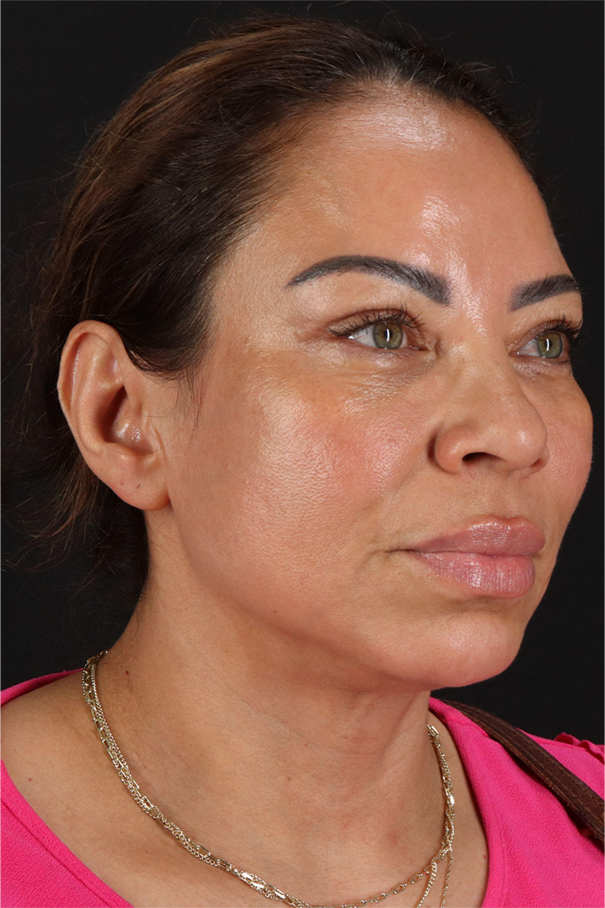 Laser Before & After Patient #3359