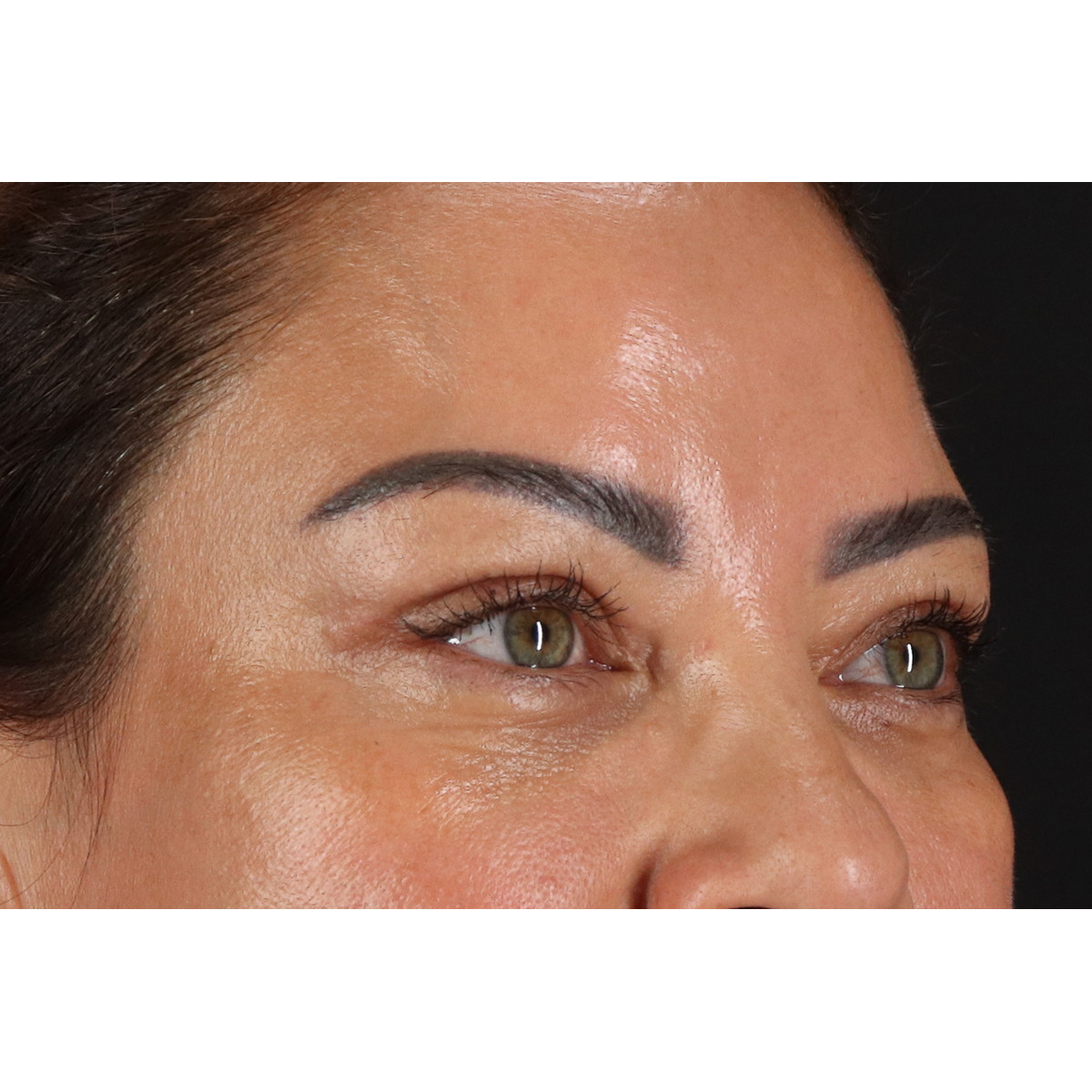 Eyelid Surgery Before & After Patient #3360