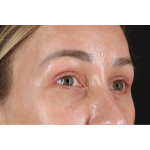 Eyelid Surgery Before & After Patient #3361