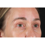Eyelid Surgery Before & After Patient #3361