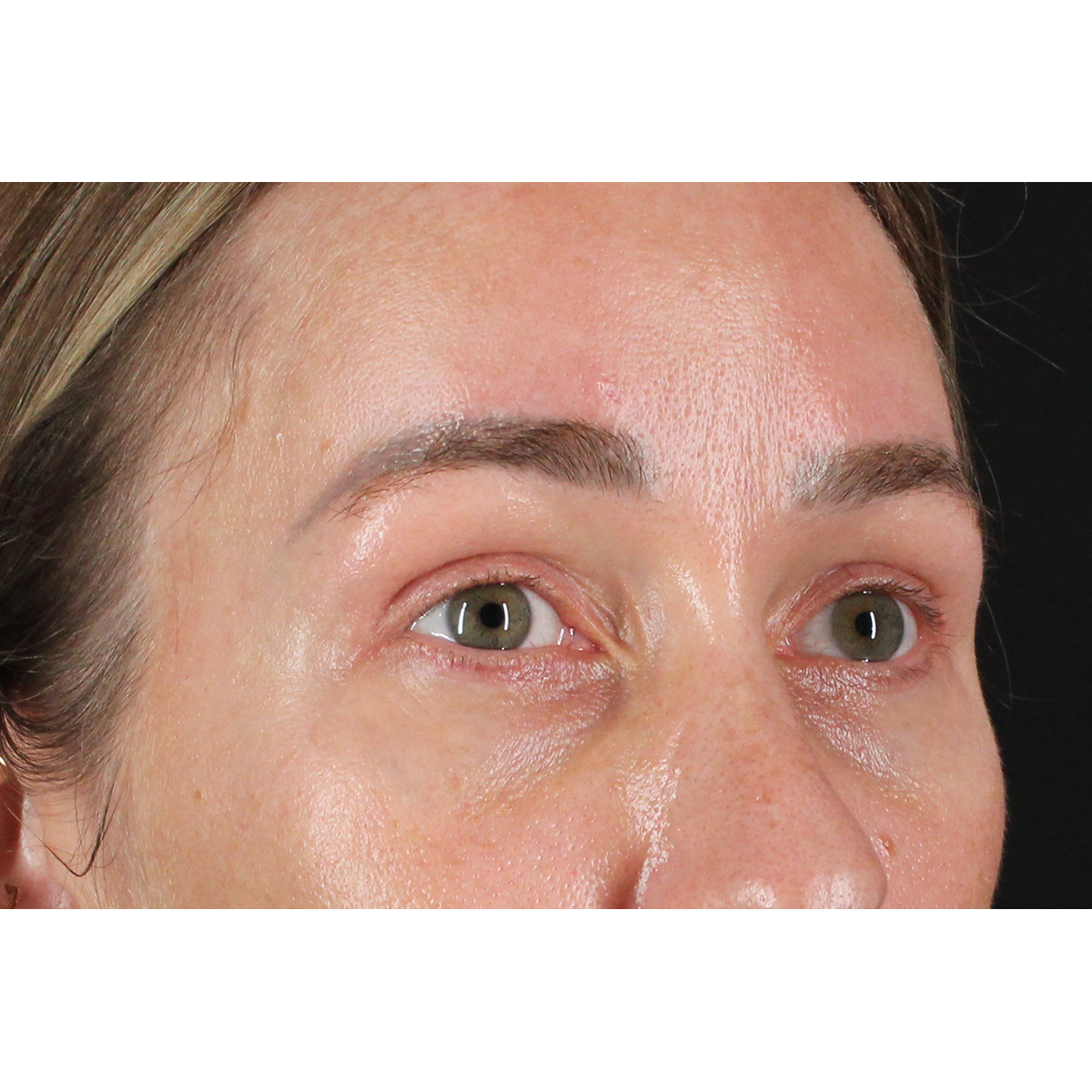 Eyelid Surgery Before & After Patient #3361