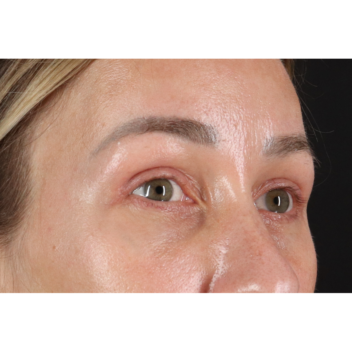 Eyelid Surgery Before & After Patient #3361