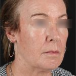 Laser Before & After Patient #3362