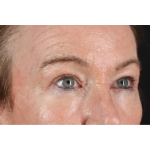 Eyelid Surgery Before & After Patient #3363