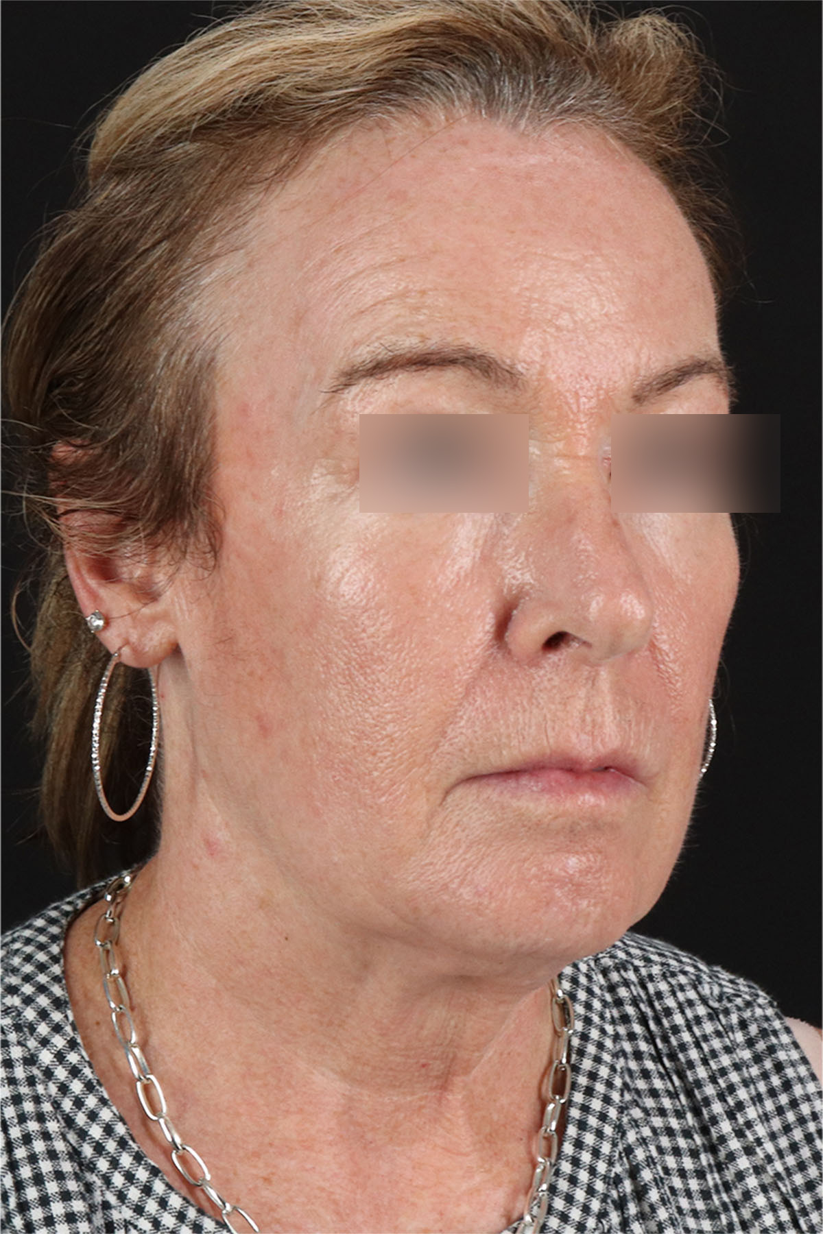 Laser Before & After Patient #3362