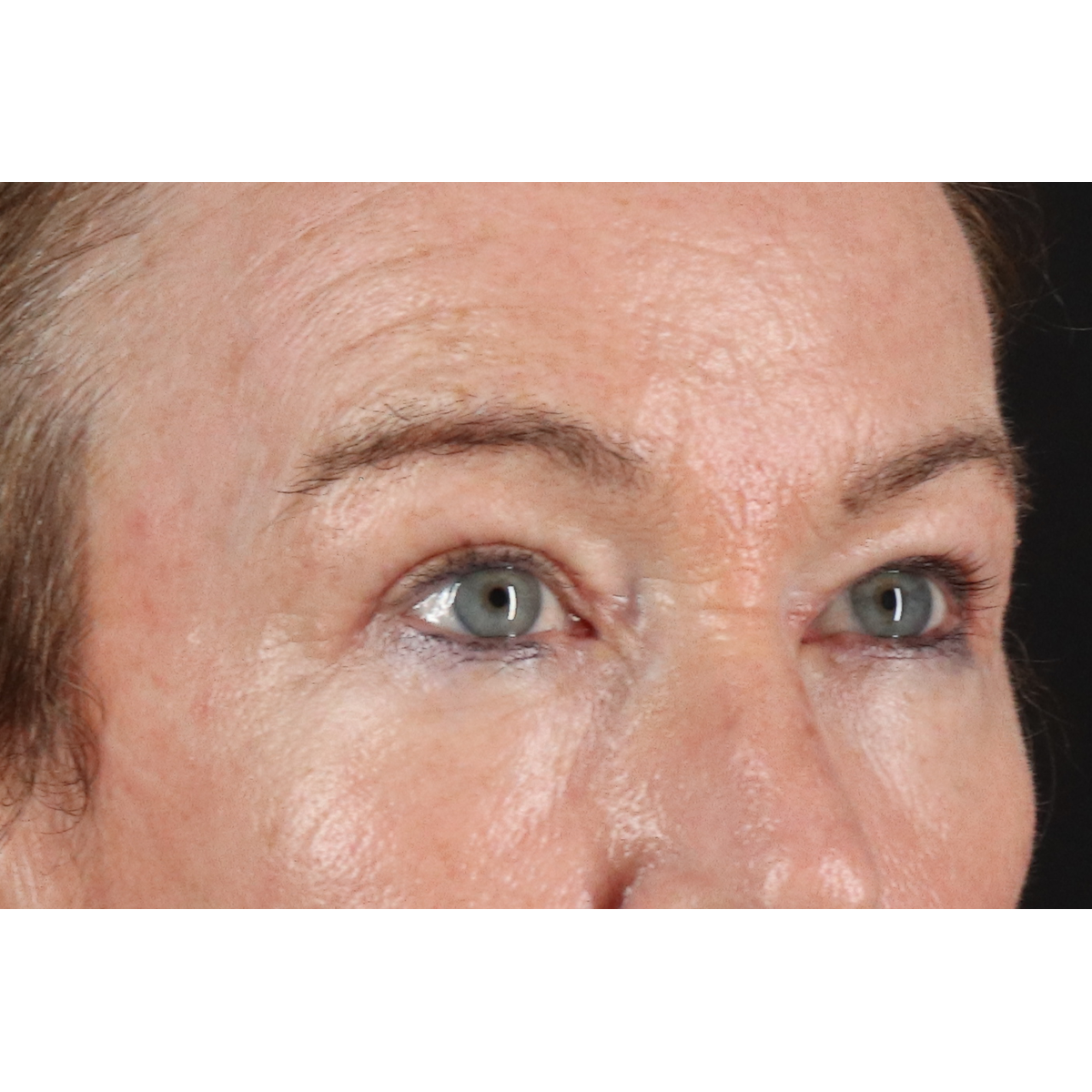 Eyelid Surgery Before & After Patient #3363