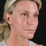 Ponytail Facelift Before & After Patient #3118