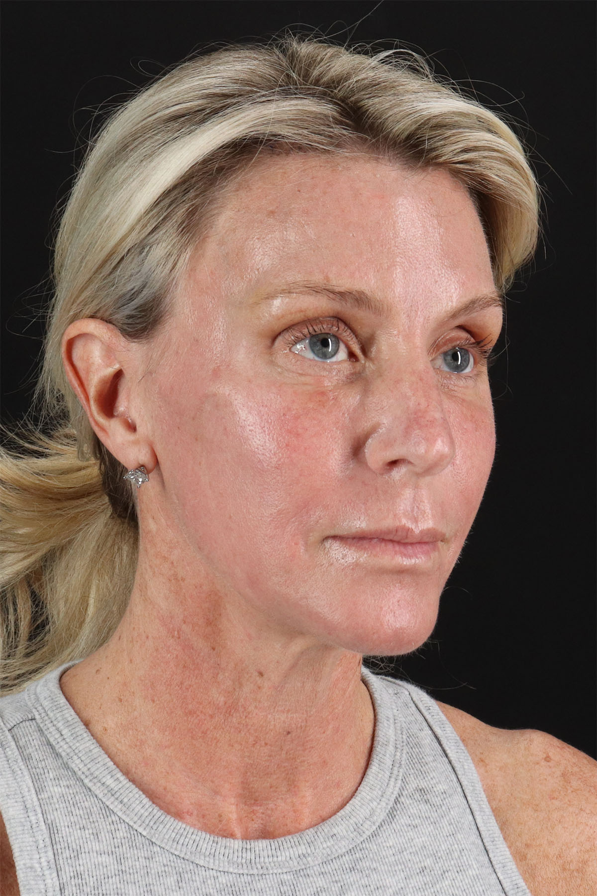 Ponytail Facelift Before & After Patient #3118