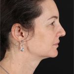 Chemical Peel Before & After Patient #3470
