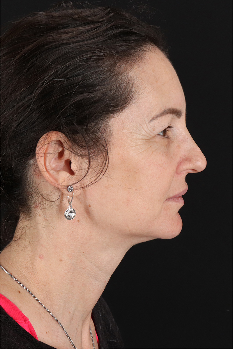 Chemical Peel Before & After Patient #3470