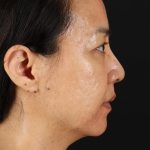 Skin Resurfacing / Laser Before & After Patient #3001
