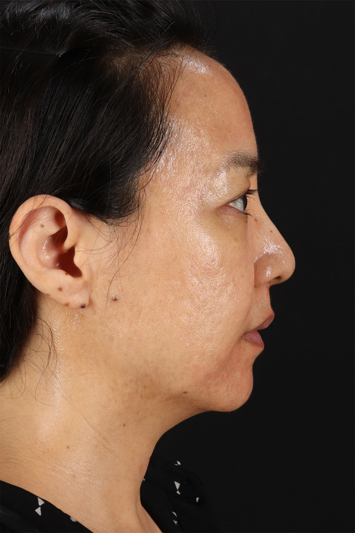 Skin Resurfacing / Laser Before & After Patient #3001