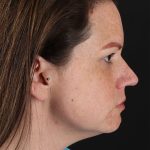 Chemical Peel Before & After Patient #3002