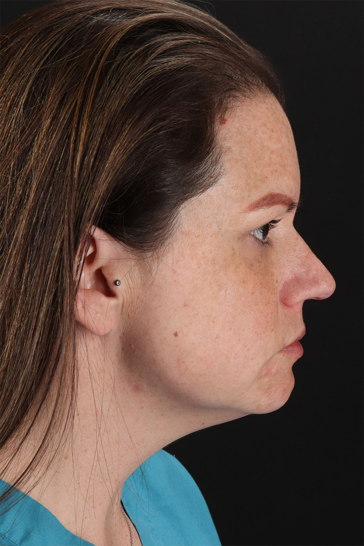 Chemical Peel Before & After Patient #3002