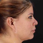 Structural Fat Grafting Before & After Patient #3642