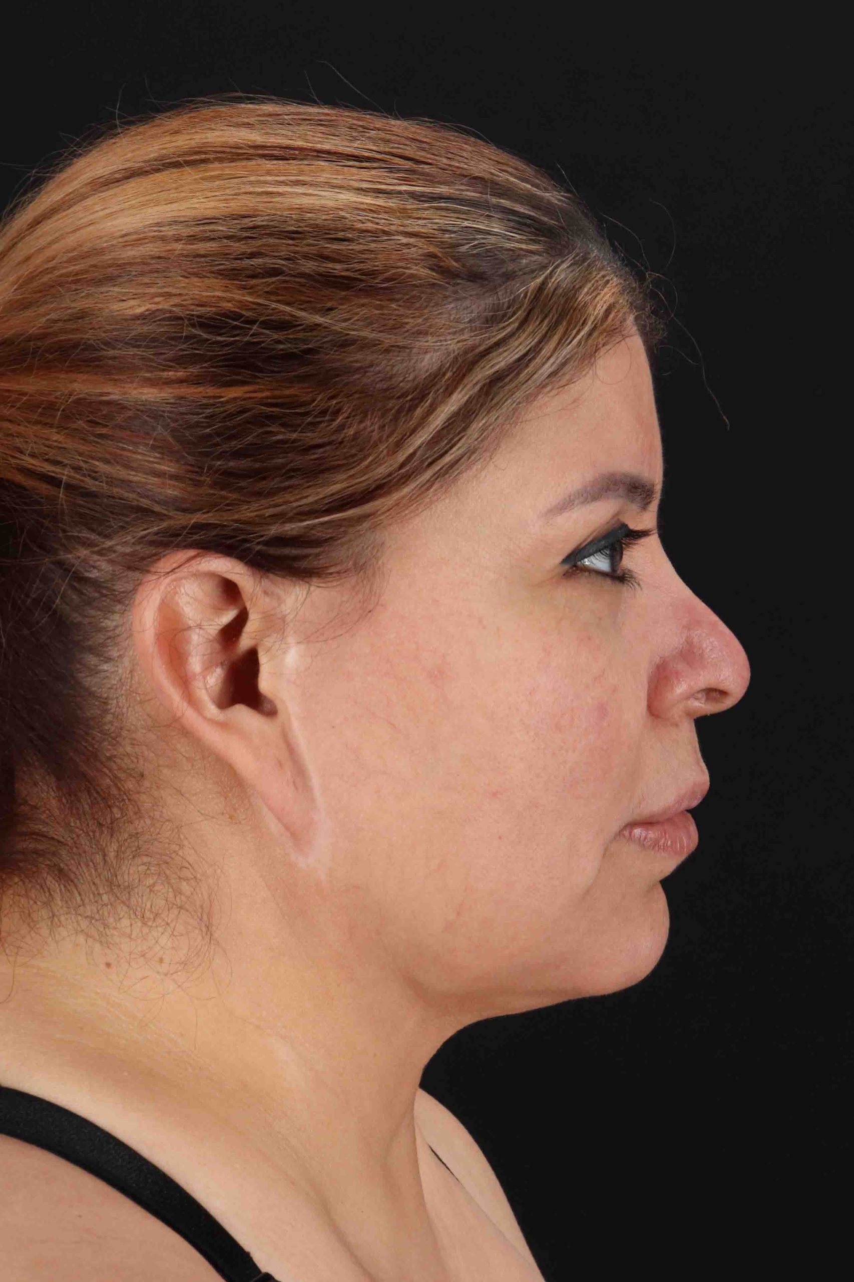 Structural Fat Grafting Before & After Patient #3642
