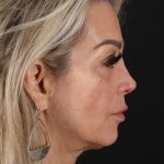 CO2 Laser Before & After Patient #3003