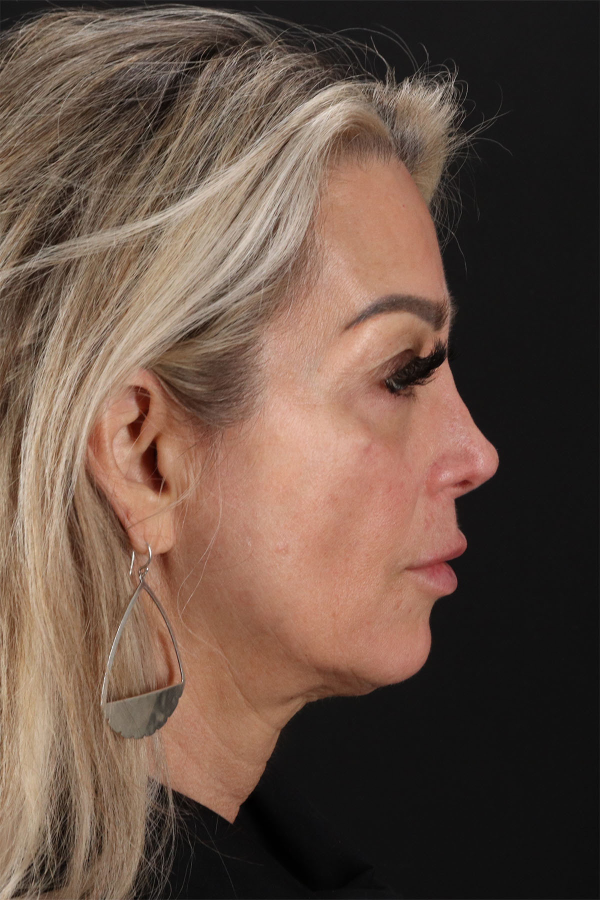 CO2 Laser Before & After Patient #3003