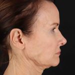 Structural Fat Grafting Before & After Patient #3643