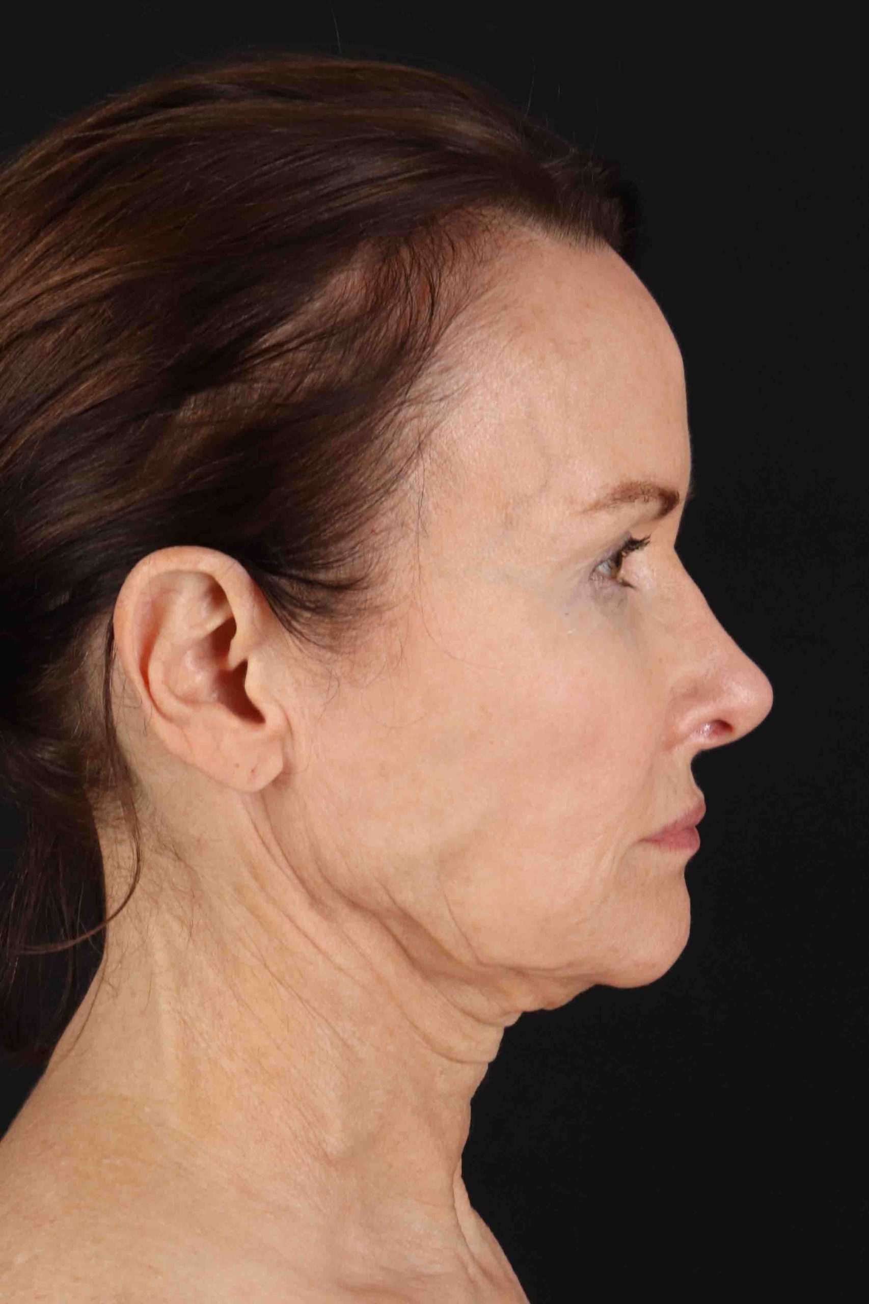 Structural Fat Grafting Before & After Patient #3643