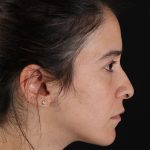 CO2 Laser Before & After Patient #3005