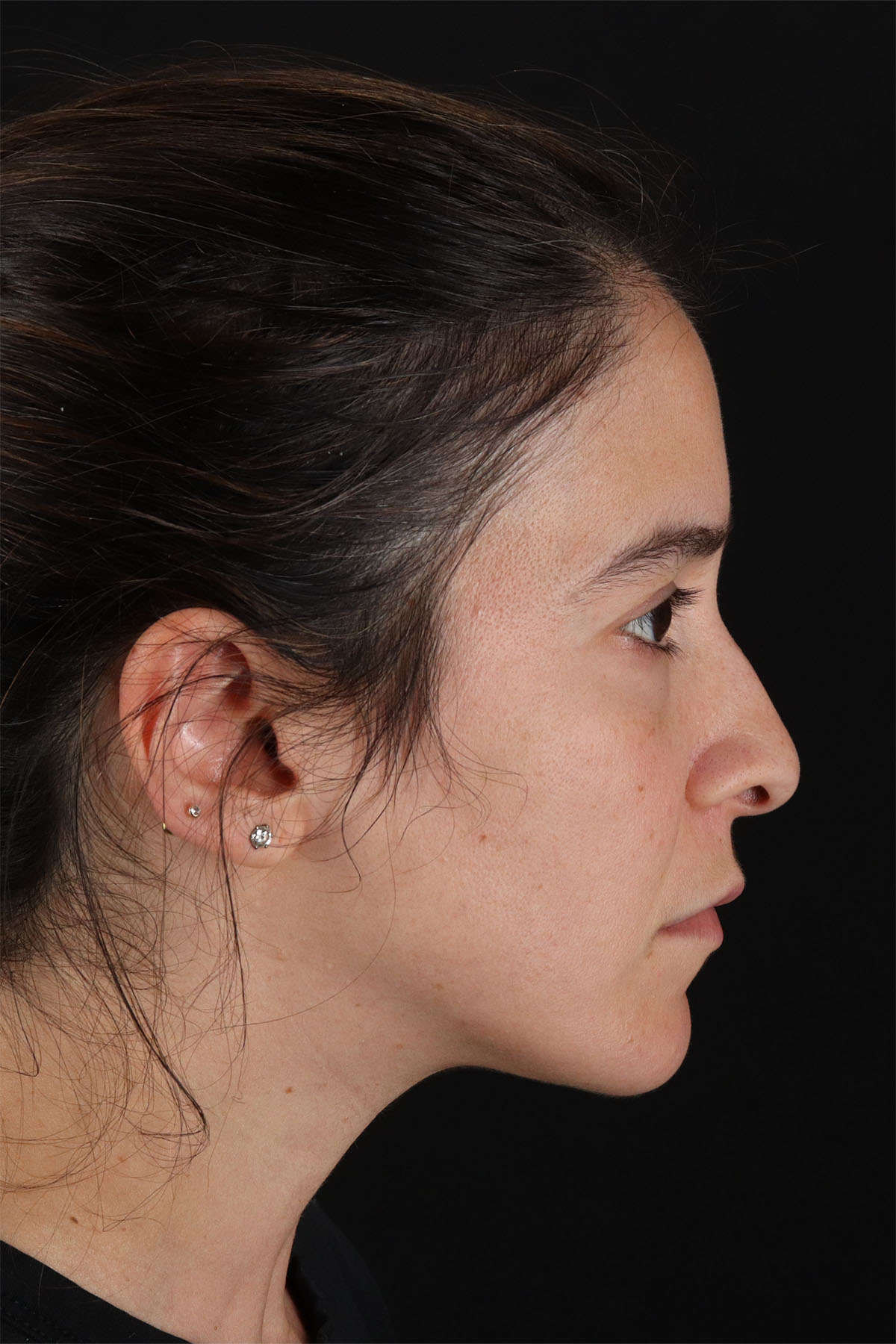 CO2 Laser Before & After Patient #3005