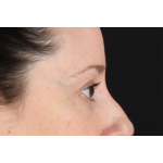 Eyelid Surgery Before & After Patient #3006