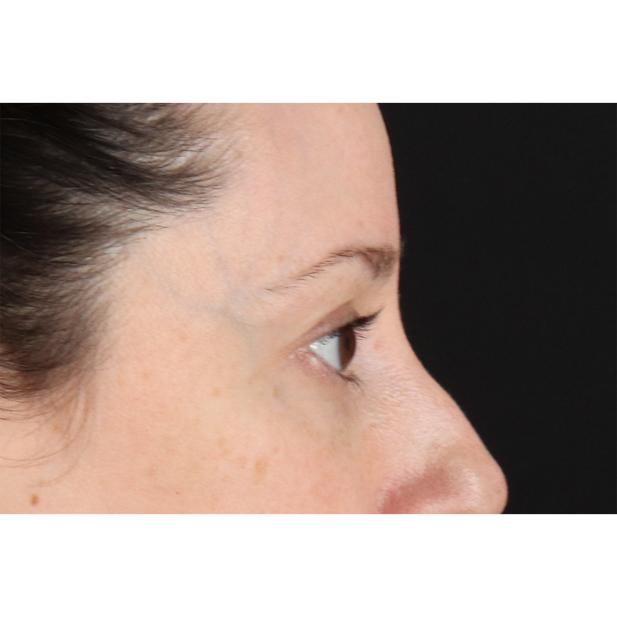 Eyelid Surgery Before & After Patient #3006